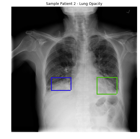 lung-opacity